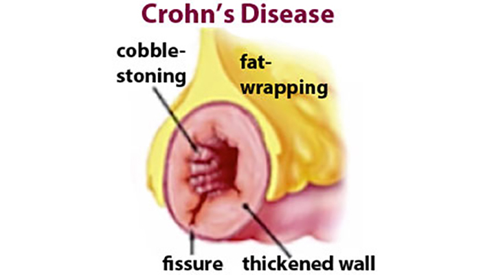 Crohn's disease and the role of bacteria in the inflammation process -  Faculty of Health Sciences