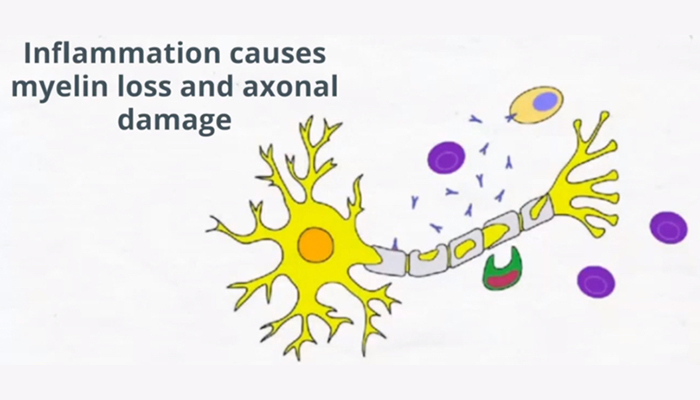 inflammation causes myelin loss and axonal damage