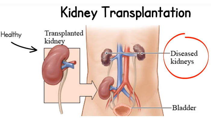 kidney transplant diagram