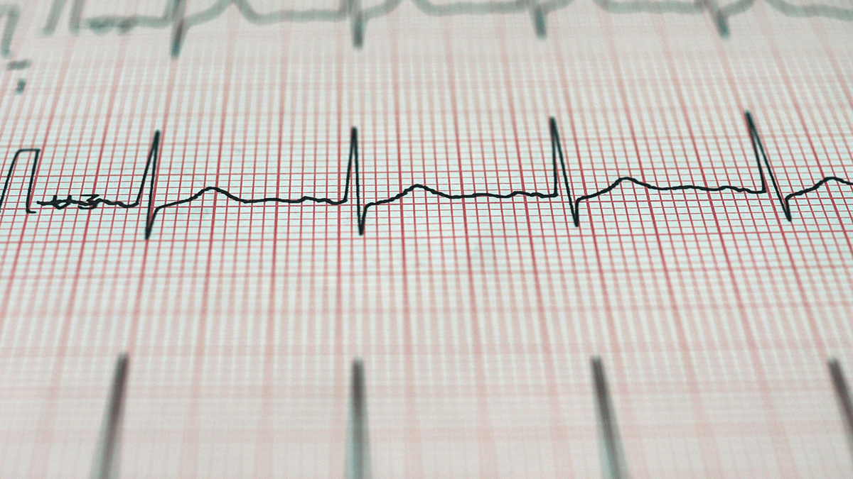 An electrocardiogram of a heart beat can be seen in this image.